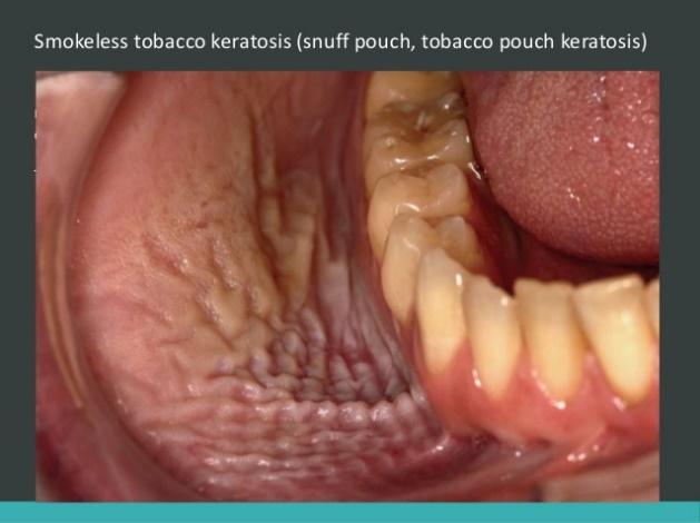 tobacco 4