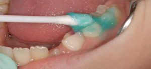 fluoride in dentistry