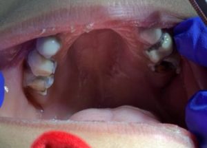 Early Childhood Caries