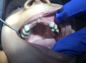 Early Childhood Caries