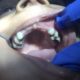 Early Childhood Caries